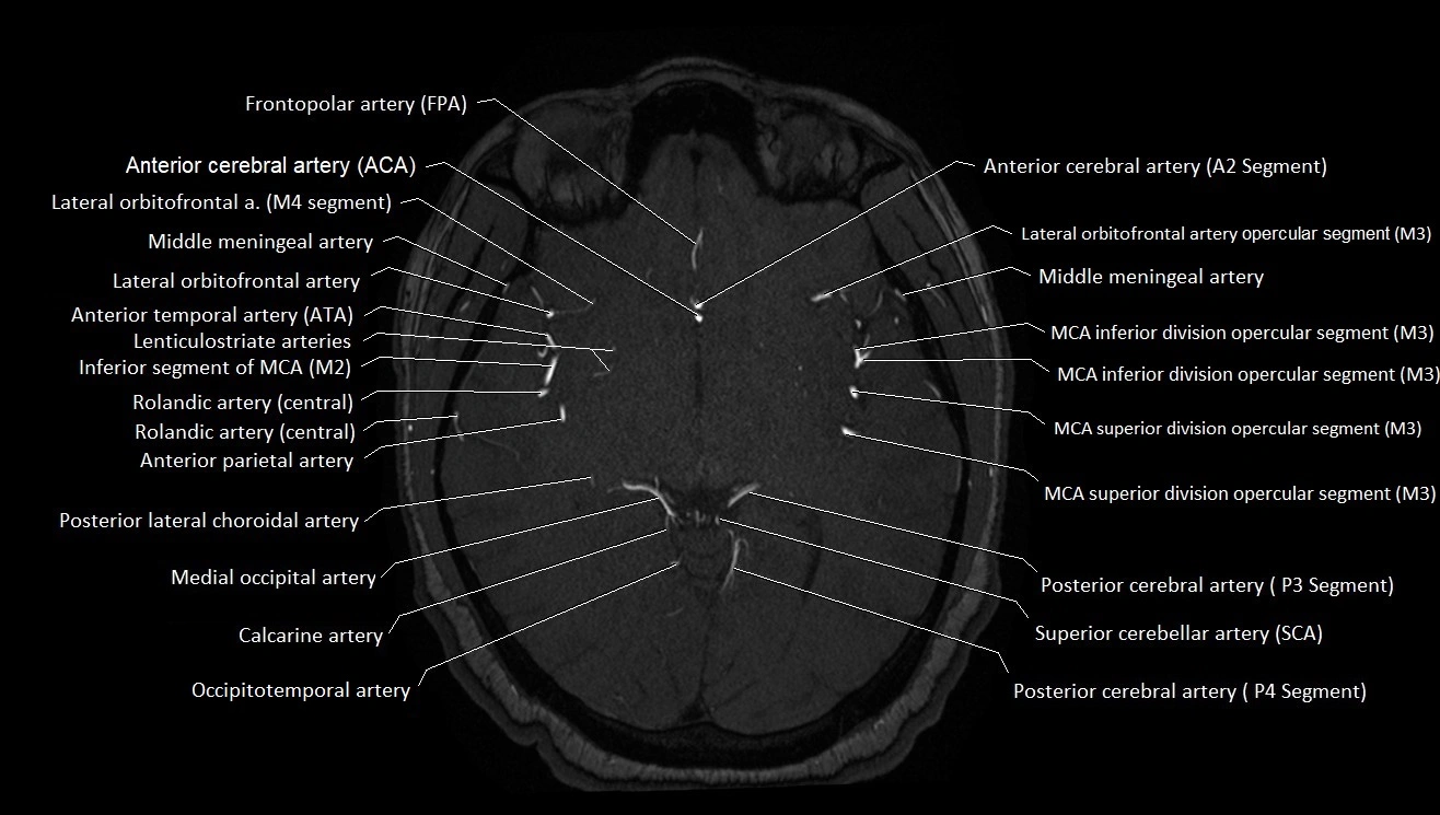 MRA brain (cerebral arteries) anatomy axial 3T image 23.webp